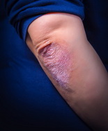 Chi è meno in forma ha maggiori probabilità di sviluppare la psoriasi